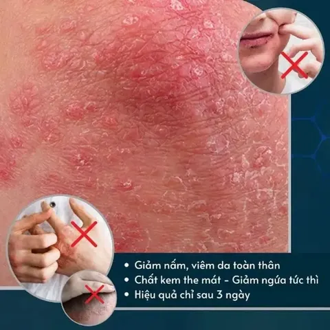 1 Hộp Kem Bôi Nấm Ngứa Viêm Da Cơ Địa NHẬT BẢN Hắc Lào, Tổ Đỉa, Vẩy Nến, Á Sừng, Lang Ben