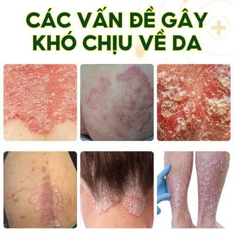 Kem bôi da liễu nhật bản Tái Tạo Da Hư Tổn Do Hắc Lào, Tổ Đỉa, Ghẻ Nước, Bỏng Nhiệt, Côn Trùng Cắn nấm glycerin Serum Mụn Diếp