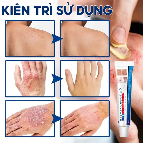 Kem bôi da liễu nhật bản Tái Tạo Da Hư Tổn Do Hắc Lào, Tổ Đỉa, Ghẻ Nước, Bỏng Nhiệt, Côn Trùng Cắn nấm glycerin Serum Mụn Diếp