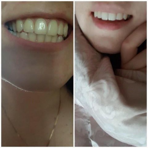 Combo 7 gói (14 miếng) miếng dán trắng răng 760317