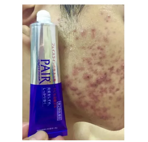 Kem  Mụn Pair Nhật Bản 14g