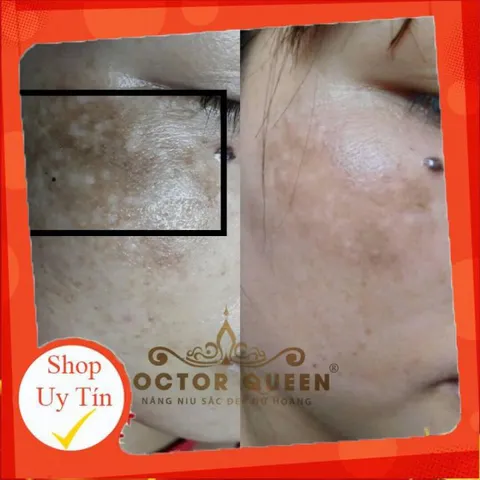 (Mẫu mới đổi tên )KEM NÁM DOCTOR QUEEN-🔥NEW🔥- (ngừa các loại nám,sạm da,tàn nhang,làm sáng da,đều màu da.,,)