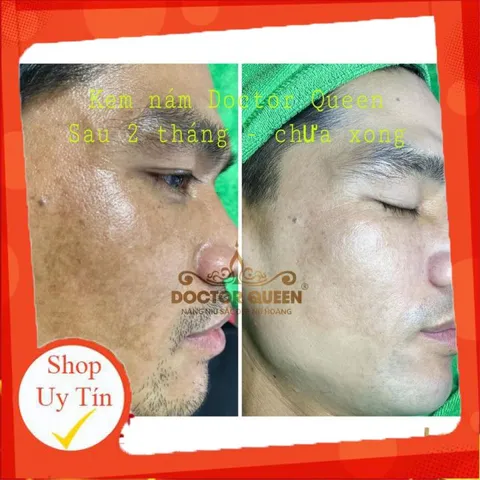 (Mẫu mới đổi tên )KEM NÁM DOCTOR QUEEN-🔥NEW🔥- (ngừa các loại nám,sạm da,tàn nhang,làm sáng da,đều màu da.,,)