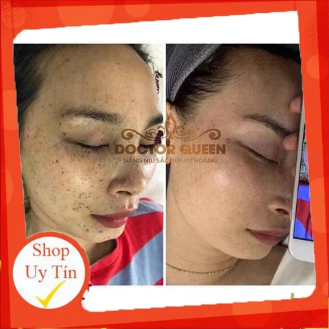 (Mẫu mới đổi tên )KEM NÁM DOCTOR QUEEN-🔥NEW🔥- (ngừa các loại nám,sạm da,tàn nhang,làm sáng da,đều màu da.,,)