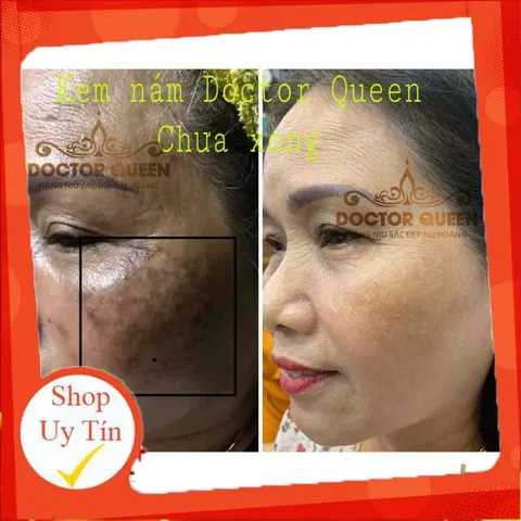 (Mẫu mới đổi tên )KEM NÁM DOCTOR QUEEN-🔥NEW🔥- (ngừa các loại nám,sạm da,tàn nhang,làm sáng da,đều màu da.,,)