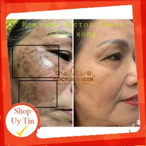 (Mẫu mới đổi tên )KEM NÁM DOCTOR QUEEN-🔥NEW🔥- (ngừa các loại nám,sạm da,tàn nhang,làm sáng da,đều màu da.,,)