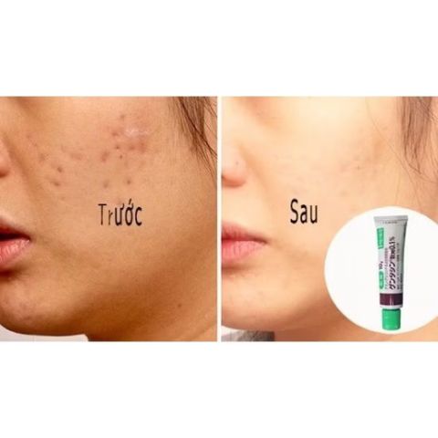 Kem Gentacin được sử dụng để giảmcác vết sẹo thâm, sẹo rỗ, sẹo mụn, giúp làm mờ sẹo và thúc đẩy làm lành da 10g