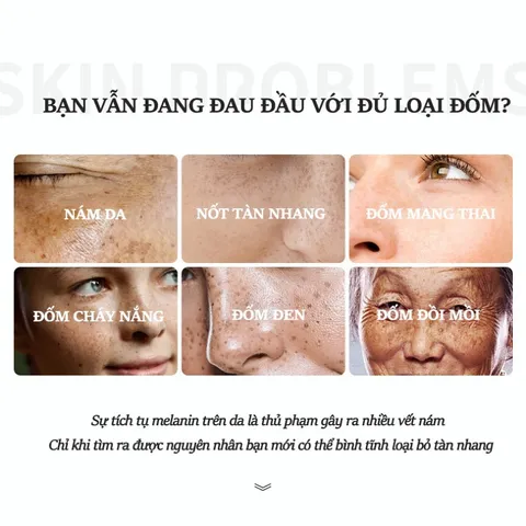 Kem trắng da và xóa tàn nhang Kem nám tàn nhang 20g kem dưỡng trắng da mặt Hiệu quả làm mờ thâm nám tàn nhang