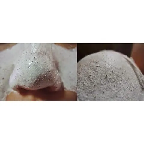 Gel lột mụn PEELING PACK hút sạch nhân mụn, làm sạch mụn cám