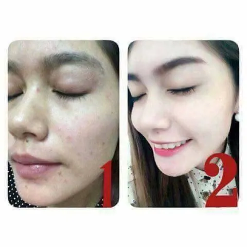 Kem hỗ trợ mụn thâm BioAqua 30ml 787911