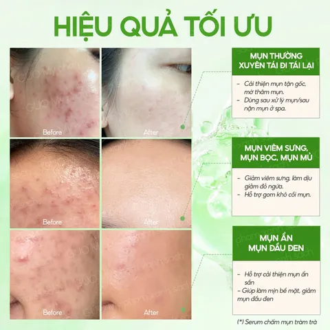 Serum Chấm Mụn GUO - Cải Thiện Mụn Hiệu Quả Với AHA 2.2%, BHA 1%, Sulfur - Sản Phẩm Chăm Sóc Da Nhạy Cảm 10ml/30ml