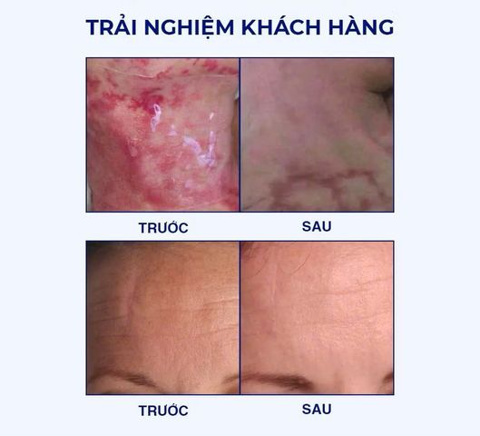 (Mỹ) Gel Làm Mờ Sẹo Rejuvaskin & Miếng Dán Sẹo Silicone Chính Hãng Hỗ Trợ Cải Thiện Sẹo Sau Phẫu Thuật, Sẹo Sau Chấn Thương, Sẹo Lồi