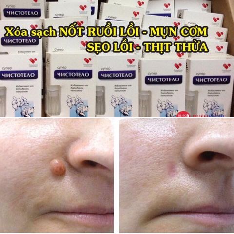 Gel Dvelinil giảm nốt ruồi, mụn cóc, mụn thịt, sẹo lồi – Nga 793318