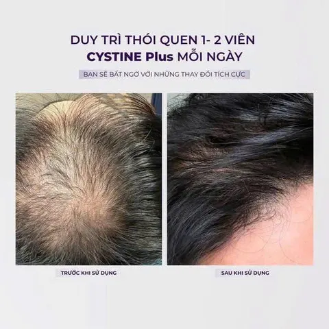 Viên Uống Cystine Plus 60 Viên Hỗ Trợ Ngăn Ngừa Rụng Tóc và Đẹp Da [hàng nhập khẩu]