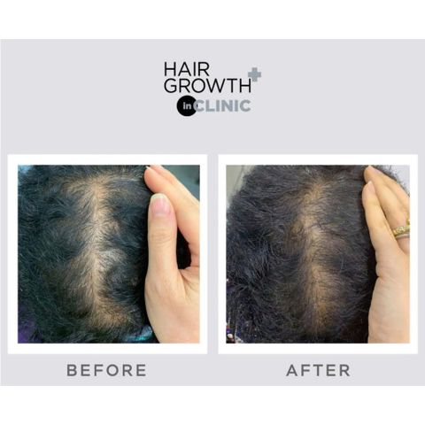 Viên Uống Hỗ Trợ Kích Thích Mọc Tóc Nam Nữ Nourkrin Hair Growth+ InClinic Hộp 90 Viên 794651