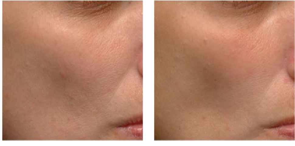 Pharmaform AZE-LIFT SERUM serum kiểm soát dầu thừa giúp thu nhỏ lỗ chân lông và cải thiện tình trạng mụn 