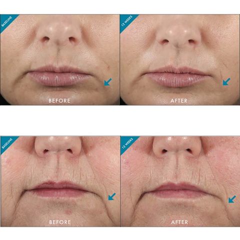 Pharmaform Hydra 5 Serum dưỡng ẩm và Pro-Vitamin B5, giúp hỗ trợ duy trì độ ẩm cho da, mang lại làn da mềm mại, căng mịn .