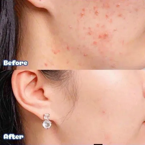 Kem Giảm Mụn Ẩn Và Thâm Gamma Megaduo Plus Gel 15gr