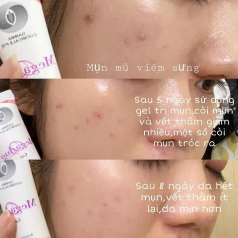 Kem Giảm Mụn Ẩn Và Thâm Gamma Megaduo Plus Gel 15gr