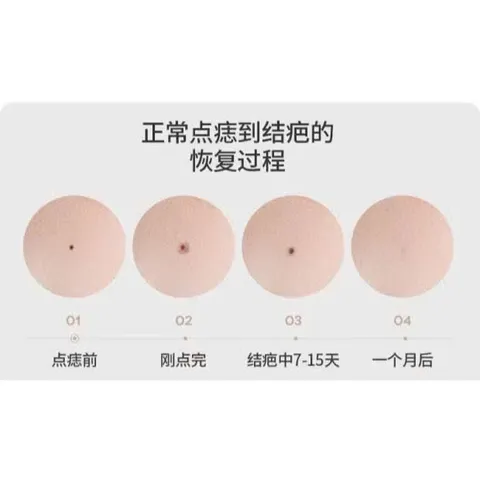 Máy Đốt Nốt Ruồi Mụn Thịt | Tàn Nhang 9 Cấp Độ Máy Đốt Nốt Ruồi Mini.