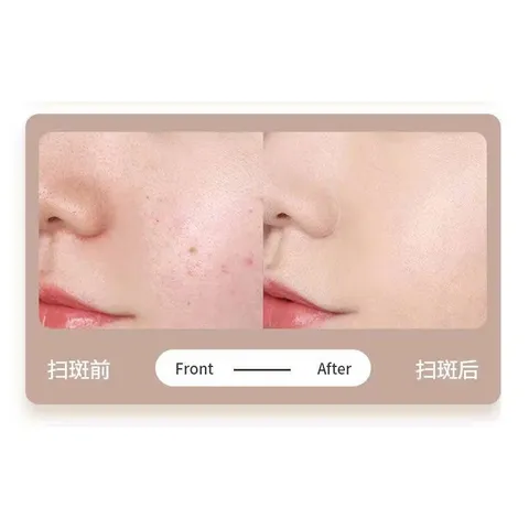 Máy Đốt Nốt Ruồi Mụn Thịt | Tàn Nhang 9 Cấp Độ Máy Đốt Nốt Ruồi Mini.