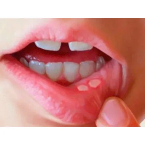 Tuýp kem bôi miệng Hàn Quốc 5ml