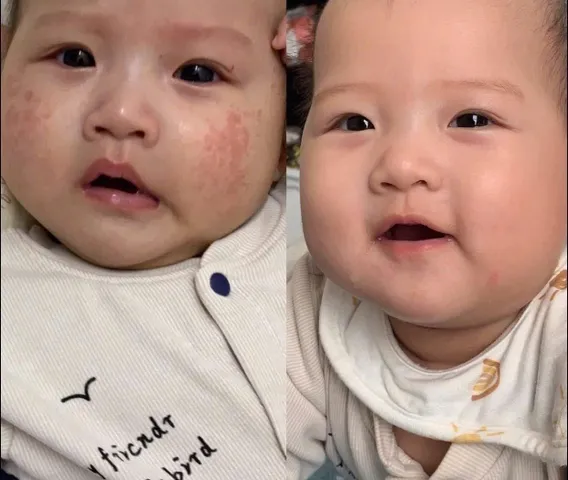(HÀNG CHÍNH HÃNG MỸ) KEM BÔI CHÀM AVEENO BABY ACZEMA THERAPY 206g