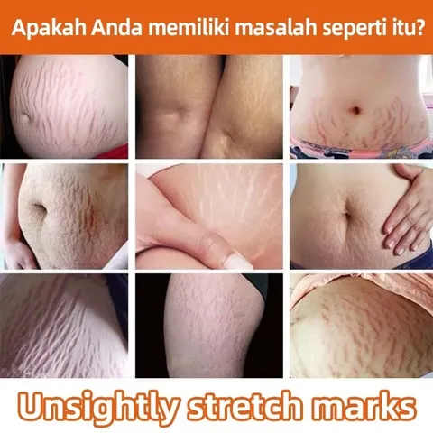 1 tuýt Kem Chống Rạn Da 40g làm mờ vết rạn dưỡng ẩm sáng da đều màu chăm sóc da săn chắc Chính Hãng