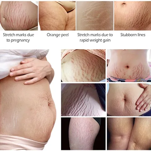 1 tuýt Kem Chống Rạn Da 40g làm mờ vết rạn dưỡng ẩm sáng da đều màu chăm sóc da săn chắc Chính Hãng