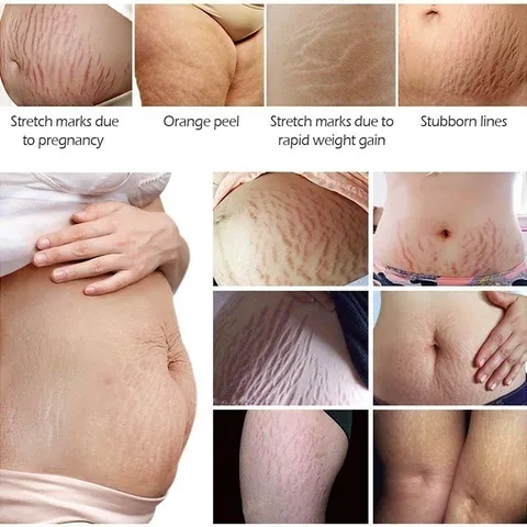 Xóa Sẹo Mang Thai Kem Rạn Da Kem Làm Săn Chắc Cơ Thể 40g Kem rạn da chống rạn da cho bà bầu làm mờ vết rạn sau sinh