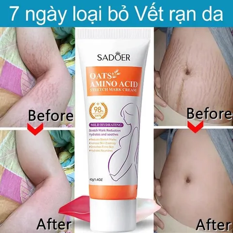 Kem xóa rạn da sau sinh mờ thâm sáng da chỉ sau 7 ngày, cải thiện sẹo rạn lâu năm, dưỡng ẩm phục hồi làn da
