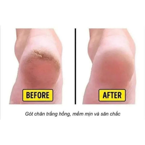 Kem nứt gót chân Hàn Quốc mềm mại da hiệu quả chất lượng