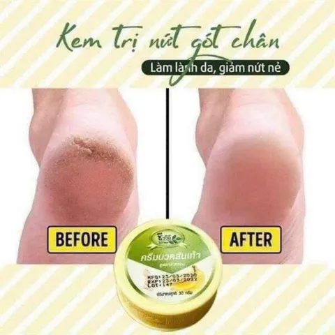 Kem giảm nứt gót chân Banana Thái 30g 809424