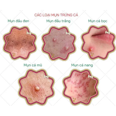 DUNG DỊCH CHĂM SÓC DA (Chai 60ml) Giúp sạch mụn trứng cá.