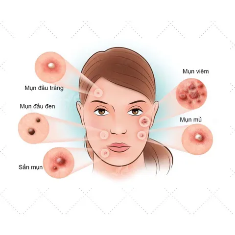 DUNG DỊCH CHĂM SÓC DA (Chai 60ml) Giúp sạch mụn trứng cá.