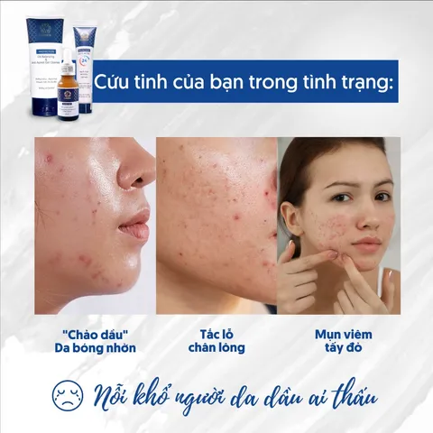 Sữa Rửa Mặt Ngừa Mụn Chuyên Biệt Cho Da Dầu C-Renew Oil Balancing Chính Hãng dạng Gel