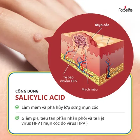 Miếng Dán Mụn Cóc Mụn Cơm Corn plaster KangDi Fobe - hộp 6 miếng