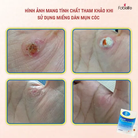 Miếng Dán Mụn Cóc Mụn Cơm Corn plaster KangDi Fobe - hộp 6 miếng