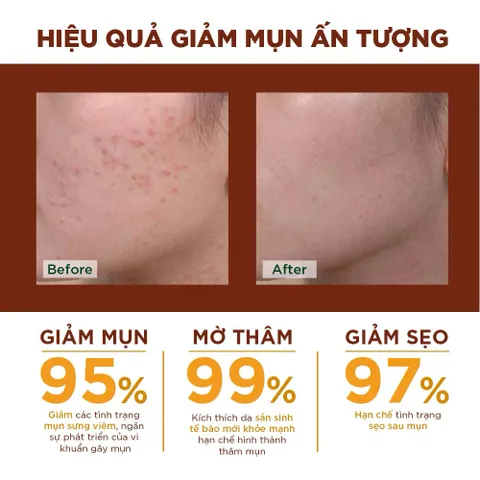 Kem nghệ Oriss giảm mụn và thâm không gây vàng da dành cho da dầu mụn tuýp 20gr