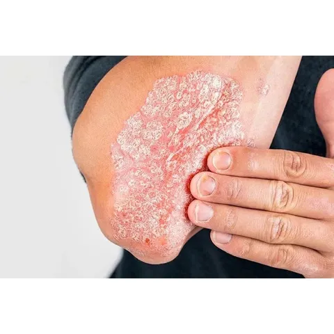 DM vả y nến ng ứa h ắc l ào la ng b en nấm kẽ tay kẽ chân
