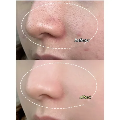Gel lột mụn đầu đen Bailamei Clean Pores 60g Than Tre Mặt nạ lột mụn cám hiệu quả an toàn tại nhà