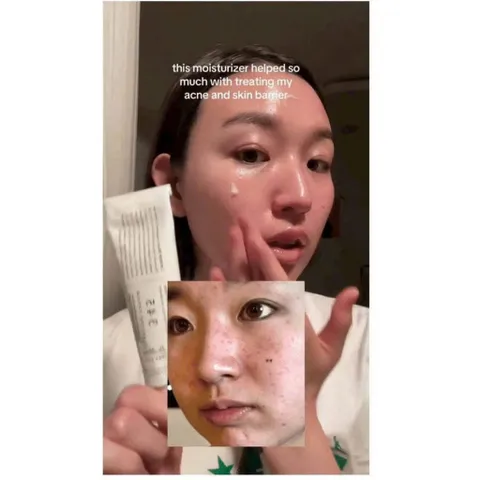 Kem dưỡng mụn gom cồi mụn Tazoretin xanh lá và phục hồi sau mụn 345 