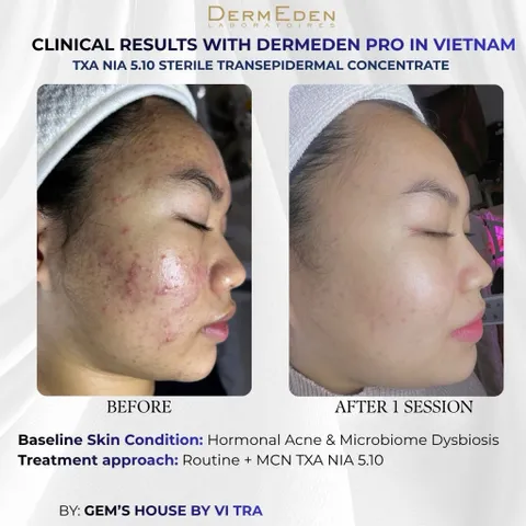 Tinh chất DermEden Mela-Protocole Hyperpigmentation TXA NIA 5.10 (5x5ml)