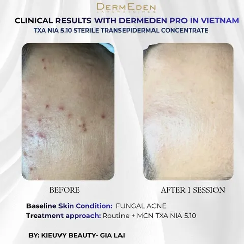 Tinh chất DermEden Mela-Protocole Hyperpigmentation TXA NIA 5.10 (5x5ml)