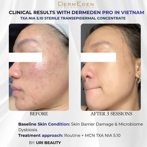Tinh chất DermEden Mela-Protocole Hyperpigmentation TXA NIA 5.10 (5x5ml)