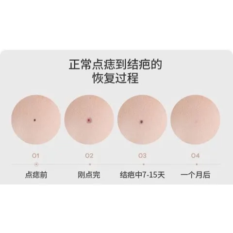 Máy Đốt Nốt Ruồi, Đốt Hôi Nách, Mụn Thịt I Máy Đốt Nốt Ruồi 9 Cấp Độ Máy Chăm Sóc Da Spa