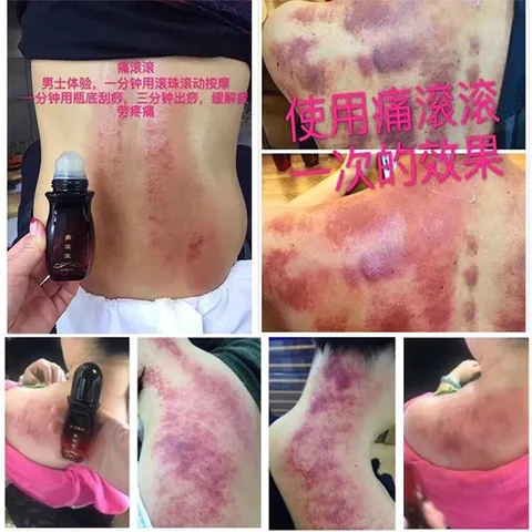 Dầu Cạo Gió, Cổn Cổn Thông Đả Thông Kinh Lạc Cải Thiện Đau Cổ Vai Gáy, Lưng Eo Tại Nhà