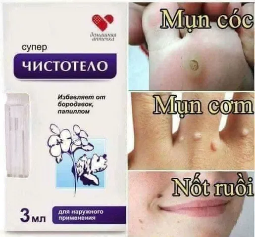 Gel Tẩy Nốt Ruồi Dvelinil 3ml - Giải Quyết Mụn Cóc, Mụn Thịt, Sẹo Lồi Hiệu Quả Không Để Lại Vết Thâm - Sản Phẩm Chính Hãng Từ Nga 820681