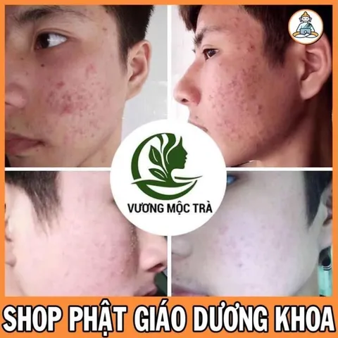 Serum tái tạo da CAO CẤP VƯƠNG MỘC TRÀ chai 30ml chuyên mụn, nám, tàn nhang, sẹo nhanh bong TẶNG BỘT