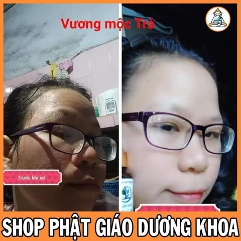 Serum tái tạo da CAO CẤP VƯƠNG MỘC TRÀ chai 30ml chuyên mụn, nám, tàn nhang, sẹo nhanh bong TẶNG BỘT